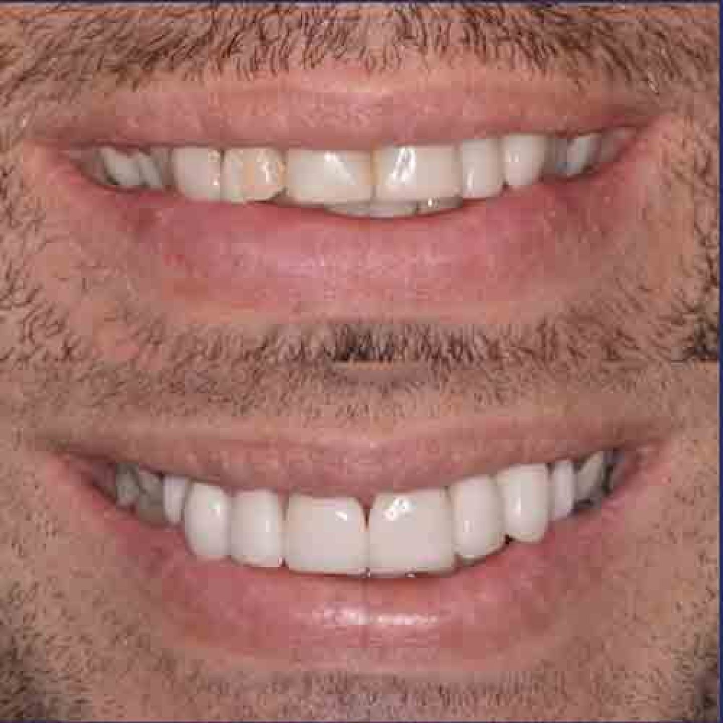 Veneers Veneers